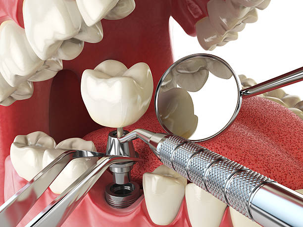 Best Emergency Dentist for Lost Fillings or Crowns in La Porte, TX