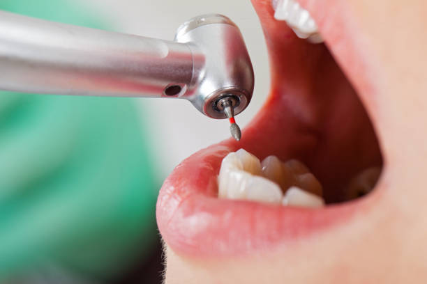 Best Emergency Dentist for Knocked-Out Tooth in La Porte, TX